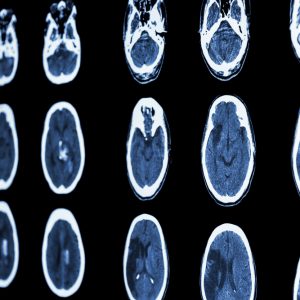 Recruitment in a CRT stroke trial